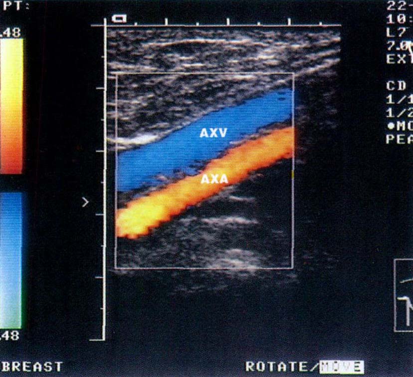 四肢动脉解剖、检查方法及正常超声图像
